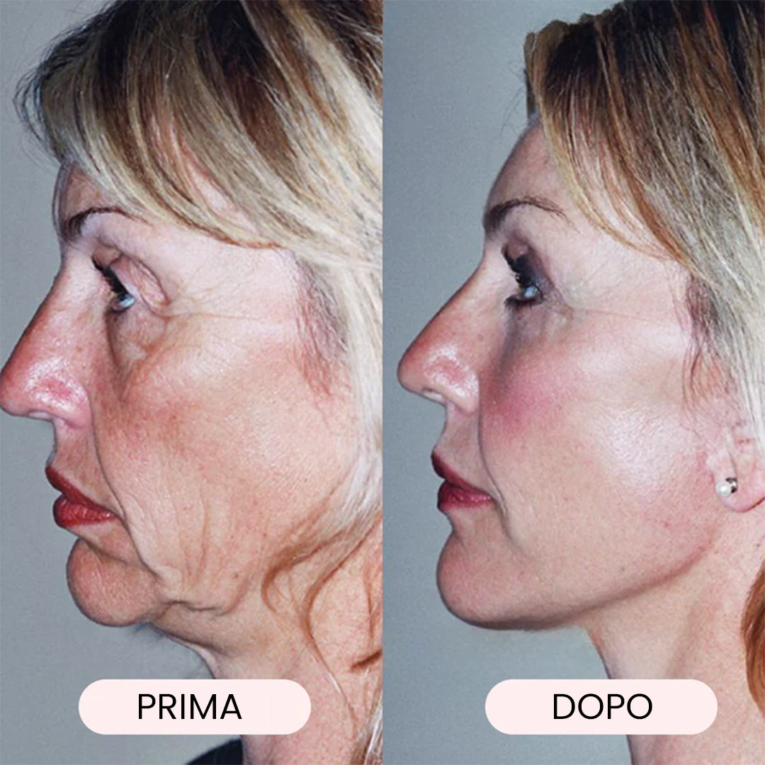 Akika V-line I Fascia per lifiting del viso