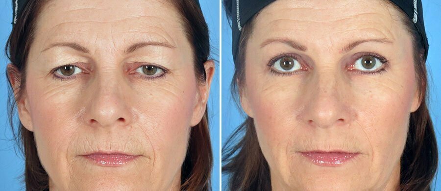 Akika™ I Gli unici cerotti per lifting palpebrale, invisibili e resistenti al trucco!