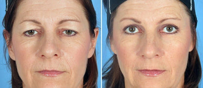 Akika™ I Gli unici cerotti per lifting palpebrale, invisibili e resistenti al trucco!